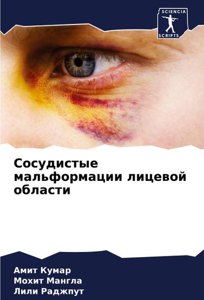 Sosudistye mal’formacii licewoj oblasti