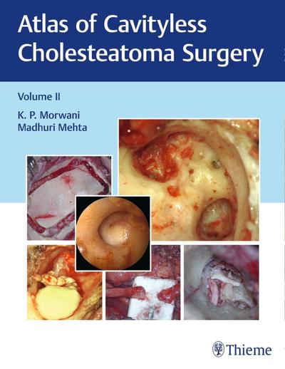 Atlas of Cavityless Cholesteatoma Surgery, Vol 2. Vol.2