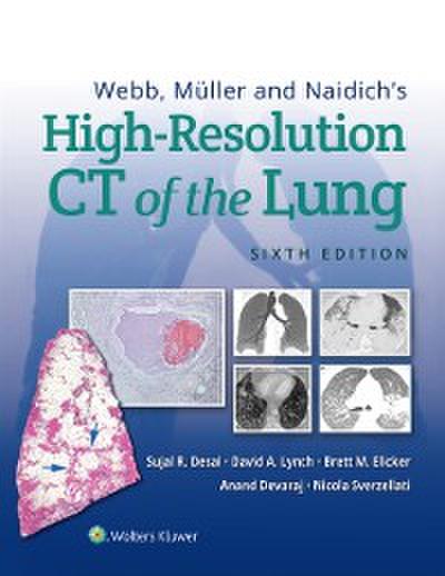 Webb, Muller and Naidich’s High-Resolution CT of the Lung