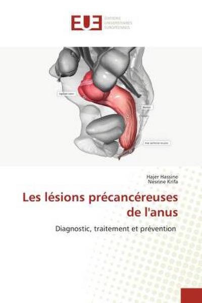 Les lésions précancéreuses de l’anus