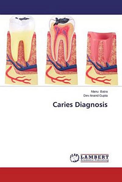 Caries Diagnosis
