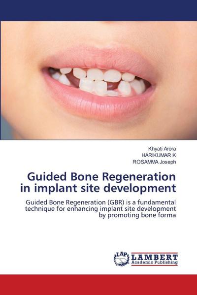 Guided Bone Regeneration in implant site development