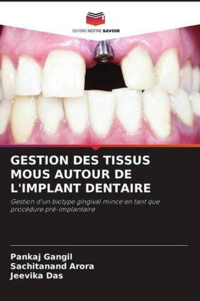 GESTION DES TISSUS MOUS AUTOUR DE L’IMPLANT DENTAIRE