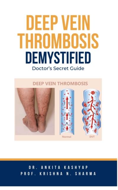 Deep Vein Thrombosis Demystified: Doctor’s Secret Guide