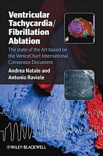 Ventricular Tachycardia / Fibrillation Ablation