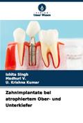 Zahnimplantate bei atrophiertem Ober- und Unterkiefer
