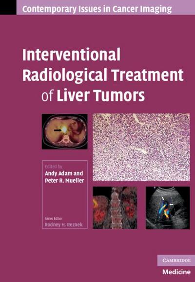 Interventional Radiological Treatment of Liver Tumors