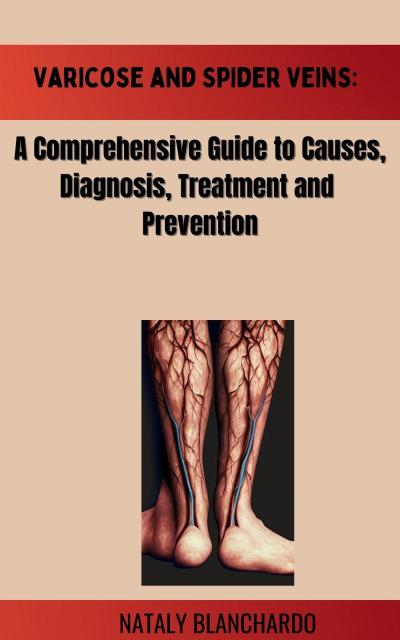 Varicose and Spider Veins: A Comprehensive Guide to Causes,Diagnosis, Treatment and Prevention