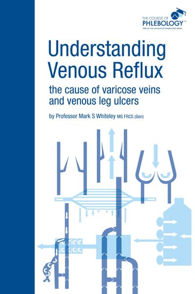 Understanding Venous Reflux the Cause of Varicose Veins and Venous Leg Ulcers
