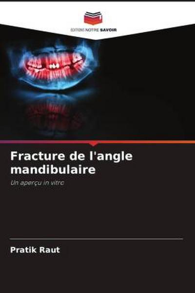 Fracture de l’angle mandibulaire