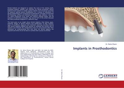 Implants in Prosthodontics