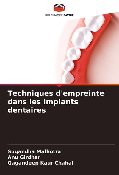 Techniques d’empreinte dans les implants dentaires