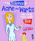 Science of Acne & Warts