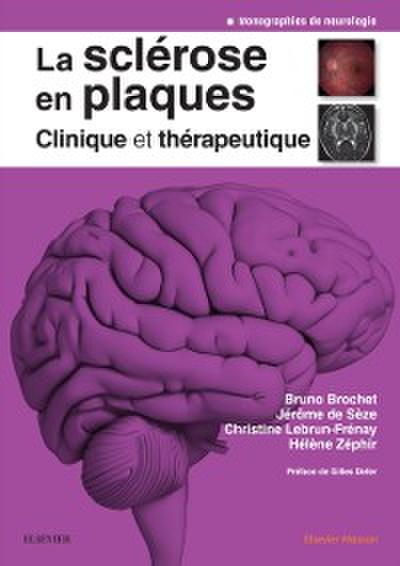 La sclerose en plaques - Clinique et therapeutique