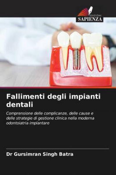 Fallimenti degli impianti dentali