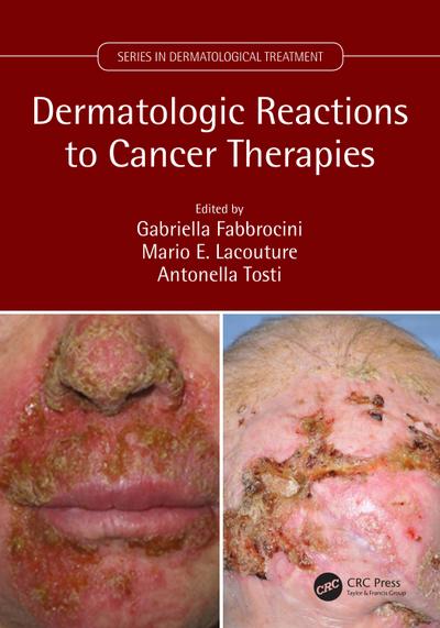 Dermatologic Reactions to Cancer Therapies