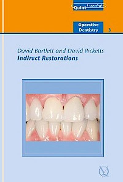 Indirect Restorations