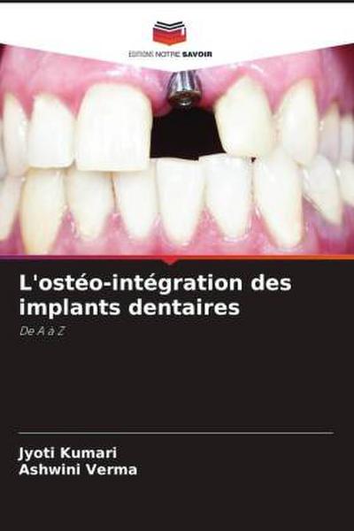 L’ostéo-intégration des implants dentaires