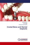 Crestal Bone and Dental Implants