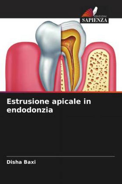 Estrusione apicale in endodonzia