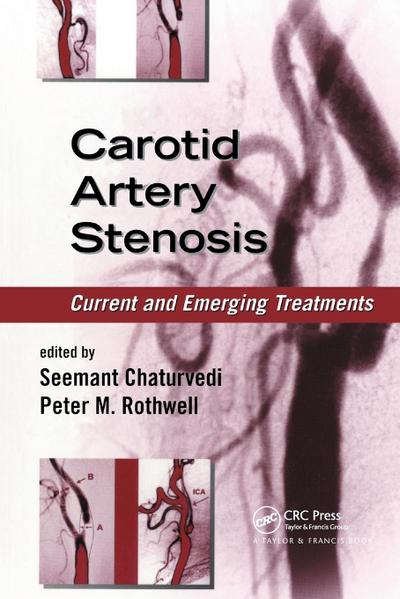 Carotid Artery Stenosis