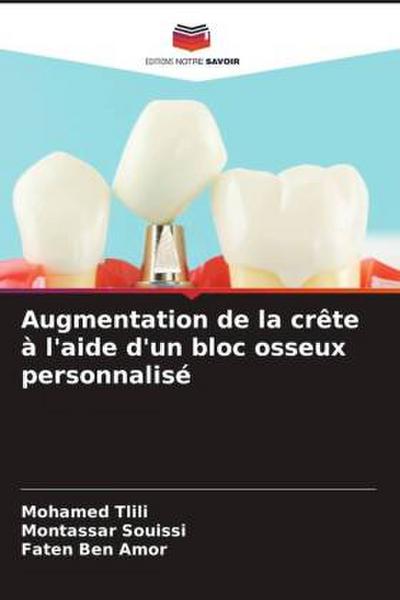 Augmentation de la crête à l’aide d’un bloc osseux personnalisé