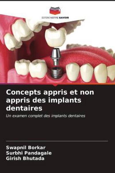 Concepts appris et non appris des implants dentaires