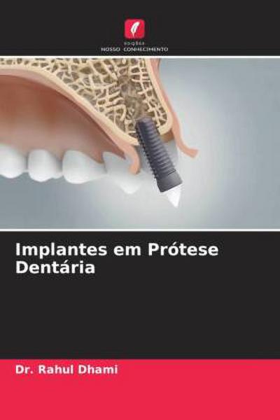 Implantes em Prótese Dentária