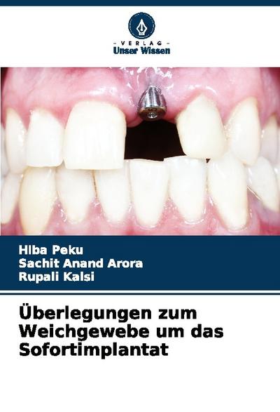 Überlegungen zum Weichgewebe um das Sofortimplantat