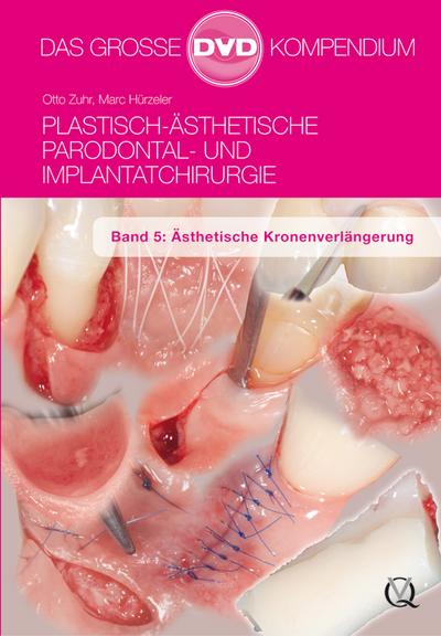 Plastisch-Ästhetische Parodontal- und Implantatchirurgie