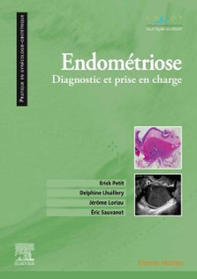 Endometriose