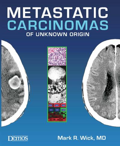 Metastatic Carcinomas of Unknown Origin