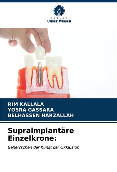 Supraimplantäre Einzelkrone:
