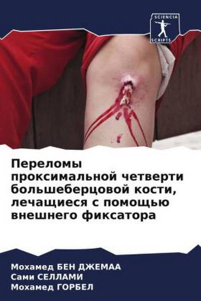 Perelomy proximal’noj chetwerti bol’shebercowoj kosti, lechaschiesq s pomosch’ü wneshnego fixatora