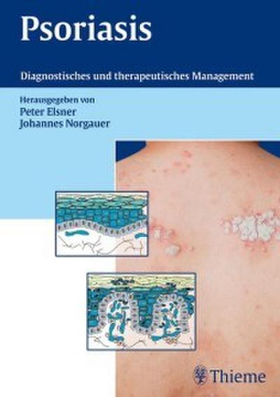 Psoriasis