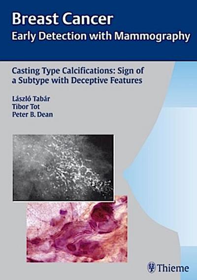 Breast Cancer Casting Type Calcifications: Sign of a Subtype with Deceptive Features