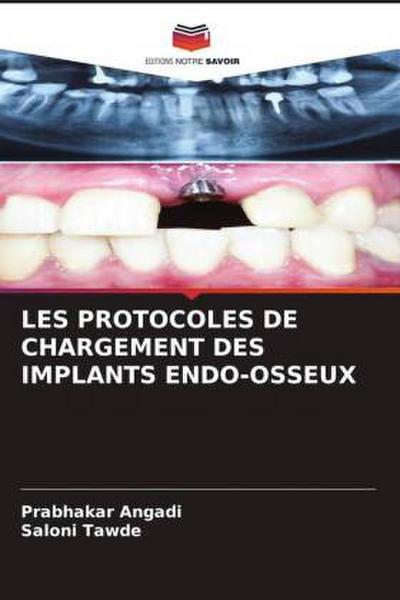 LES PROTOCOLES DE CHARGEMENT DES IMPLANTS ENDO-OSSEUX