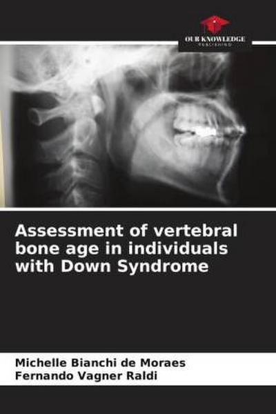 Assessment of vertebral bone age in individuals with Down Syndrome