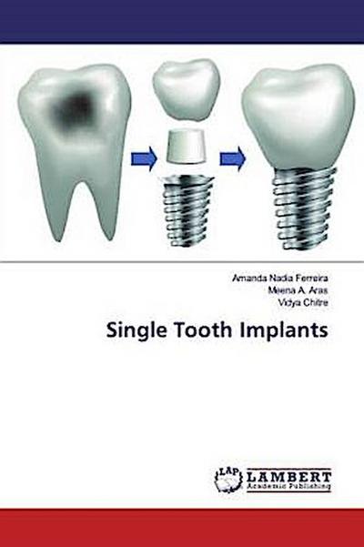 Single Tooth Implants