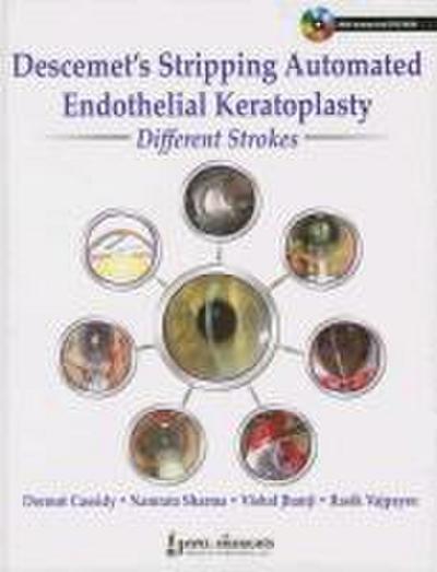 Descemet’s Stripping Automated Endothelial Keratoplasty