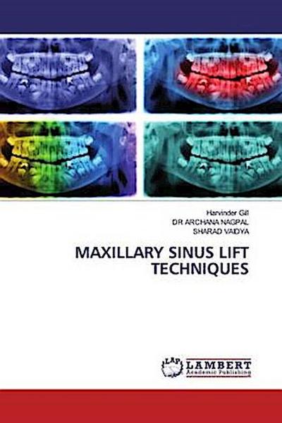 MAXILLARY SINUS LIFT TECHNIQUES