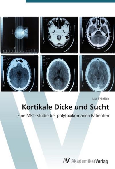 Kortikale Dicke und Sucht