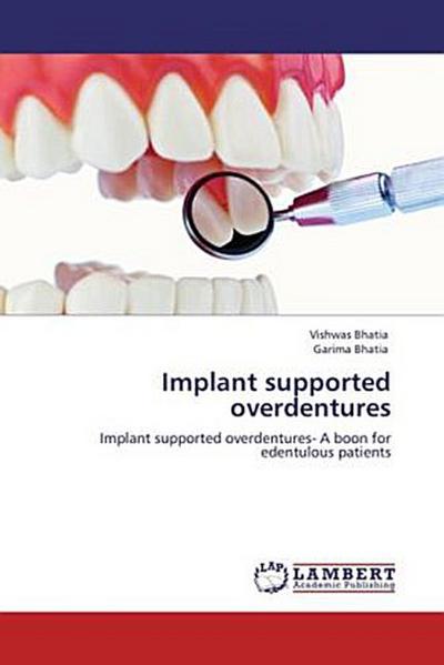 Implant supported overdentures