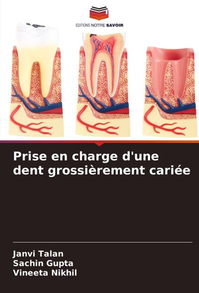 Prise en charge d’une dent grossièrement cariée