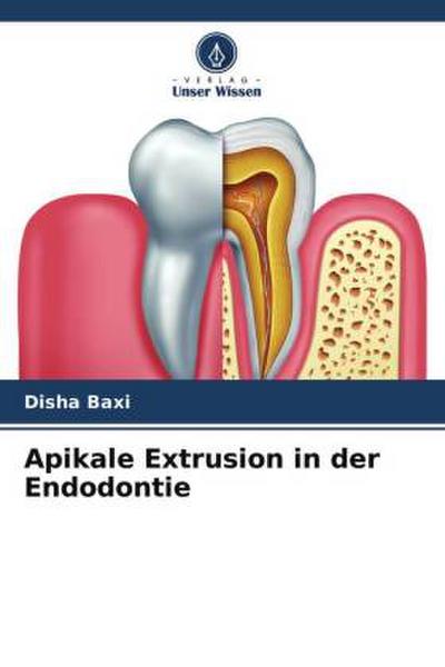 Apikale Extrusion in der Endodontie