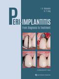 Peri-Implantitis