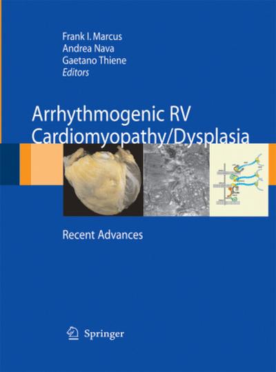 Arrhythmogenic RV Cardiomyopathy/Dysplasia