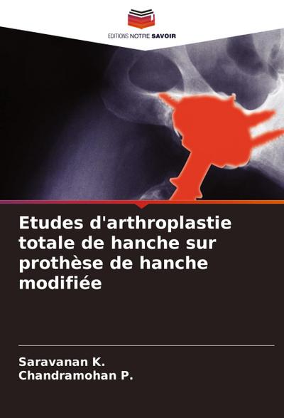 Etudes d’arthroplastie totale de hanche sur prothèse de hanche modifiée