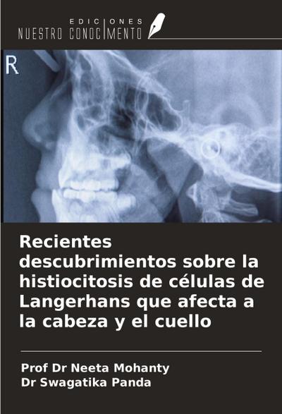 Recientes descubrimientos sobre la histiocitosis de células de Langerhans que afecta a la cabeza y el cuello