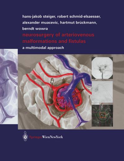 Neurosurgery of arteriovenous malformations and fistulas